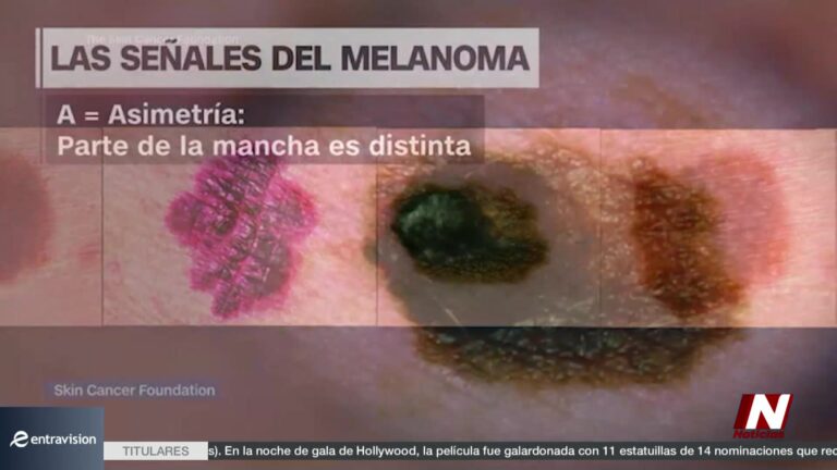Melanoma: Detectar A Tiempo Es Vital Para Salvar Vidas