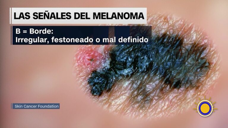 Melanoma: El Cáncer De Piel Más Agresivo Y Cómo Detectarlo A Tiempo