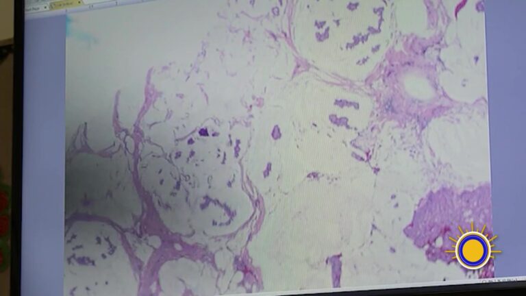 Inteligencia Artificial Da Esperanza Contra El Cáncer De Ovario De Difícil Detección